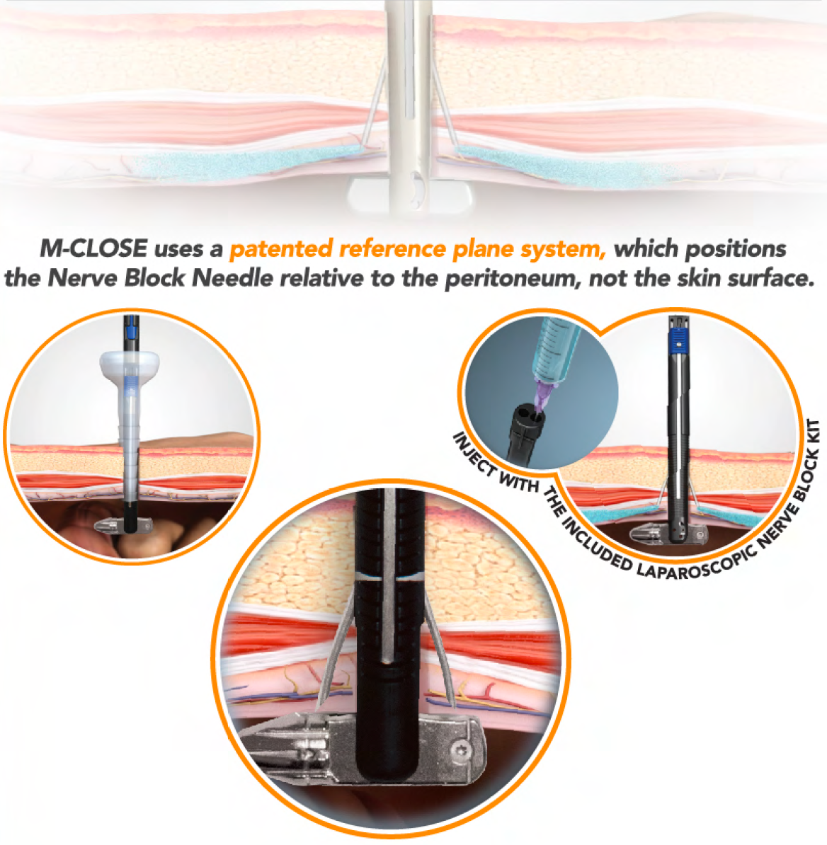 M-Close Kit for targeted local anaesthetic administration of laparoscopic port sites